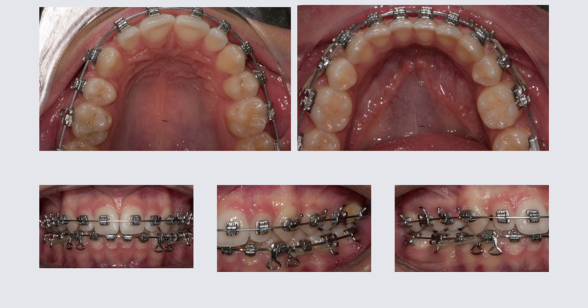 trattamento ortodontico preprotesico